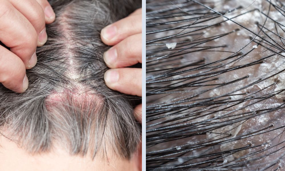 Dầu gội Aromase Oily Balancing ngăn chặn nấm Malassezia gây gàu nhờn 2