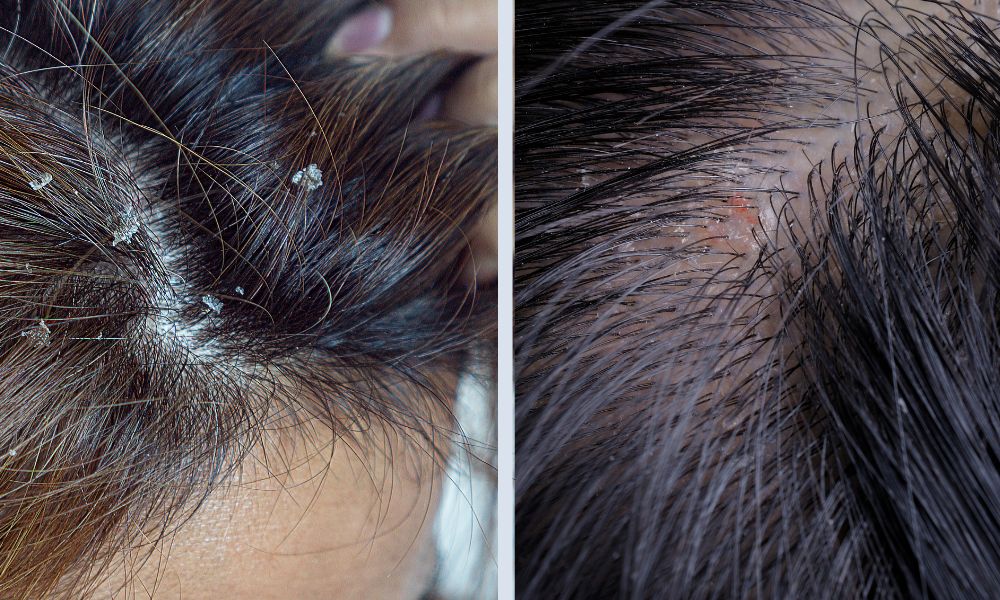 Dầu gội Aromase Oily Balancing ngăn chặn nấm Malassezia gây gàu nhờn