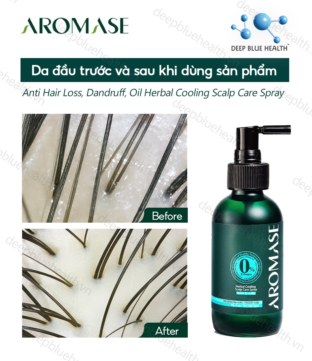 Xịt giảm viêm da đầu Aromase: Làm dịu, hết ngứa tức thì5