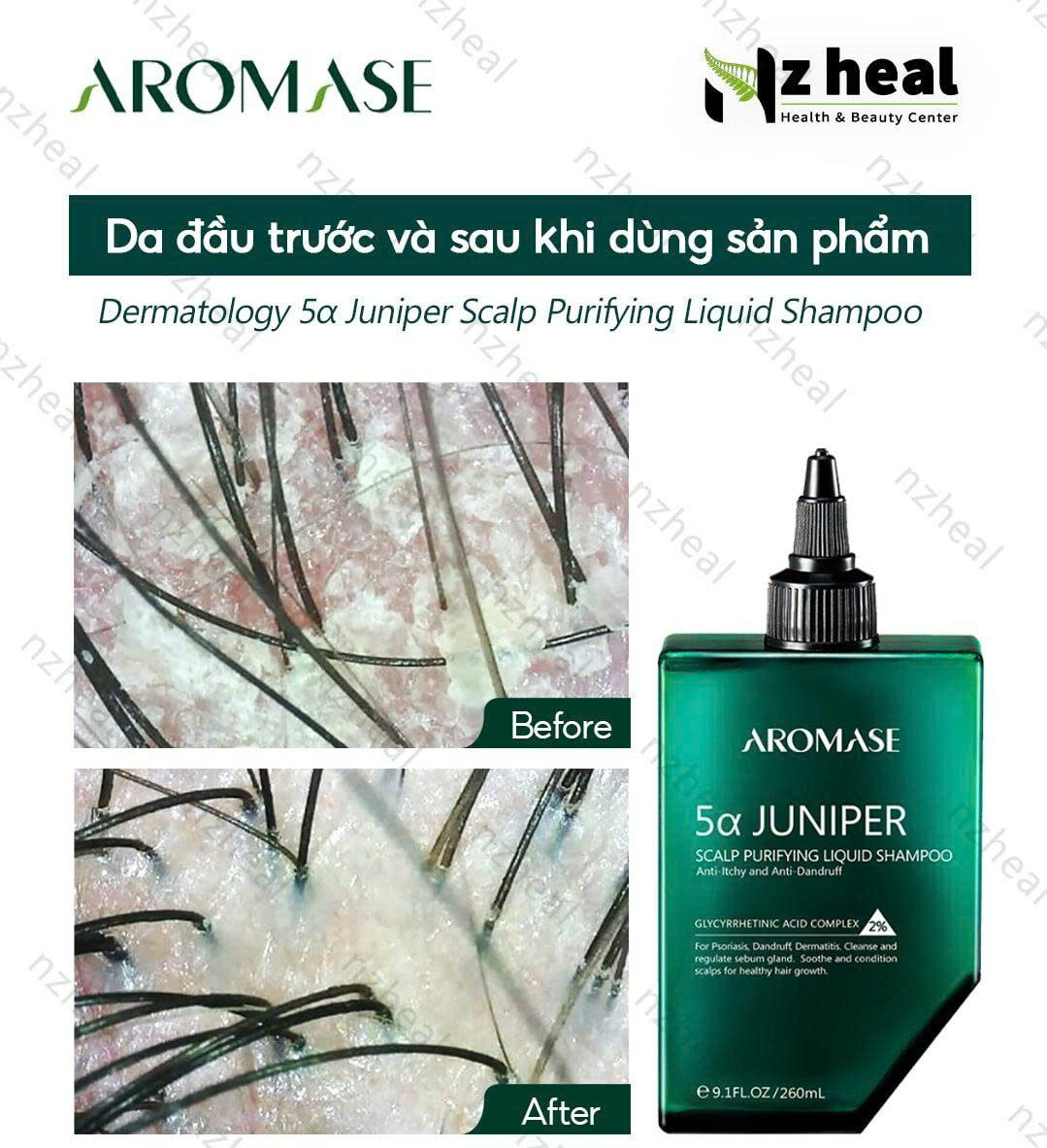 Da đầu dầu nhưng tóc khô? Làm sạch sâu bằng Tẩy tế bào chết da đầu Aromase Purifying Liquid 3