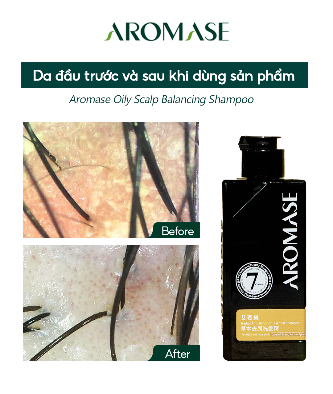 Cơ chế loại bỏ gàu dai dẳng từ Dầu gội trị gàu Oily Scalp Balancing 1