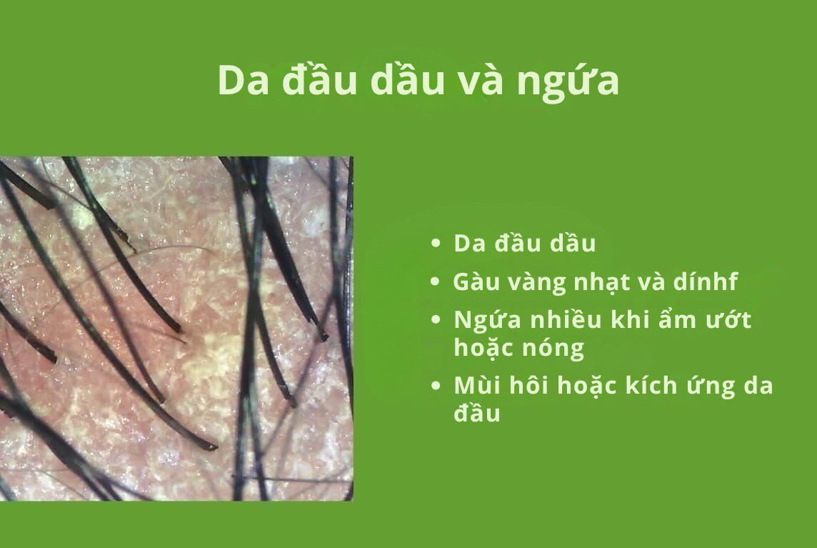 Ngứa ở da đầu dầu và khô: Sự khác biệt, nguyên nhân, dấu hiệu và cách xử lý 1