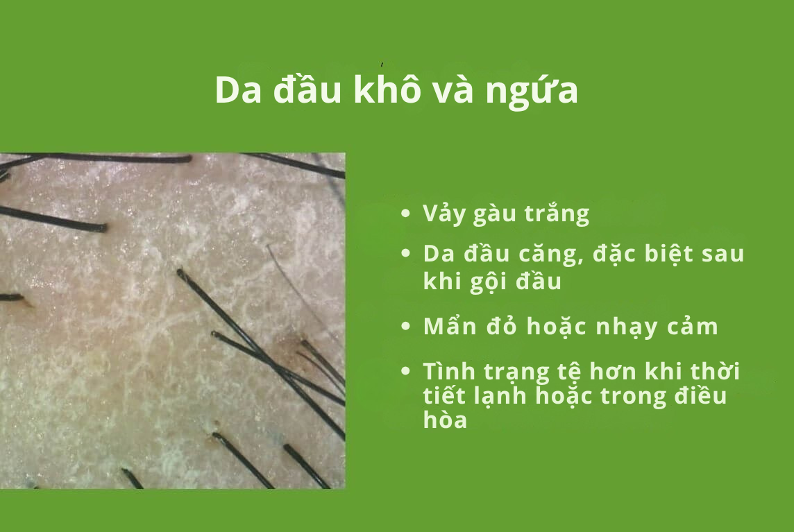 Ngứa ở da đầu dầu và khô: Sự khác biệt, nguyên nhân, dấu hiệu và cách xử lý 2
