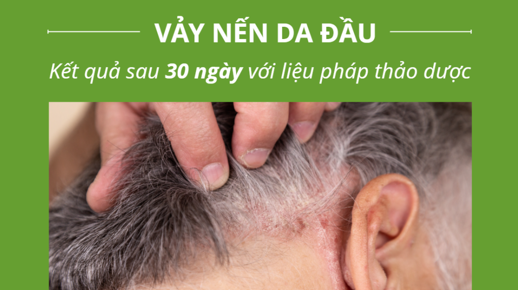 Bệnh vảy nến da đầu: Kết quả điều trị sau 30 ngày với liệu pháp thảo dược